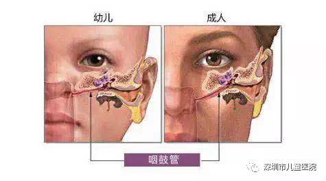 儿科医生呼吁:孩子感冒后易得这病,5岁娃差点