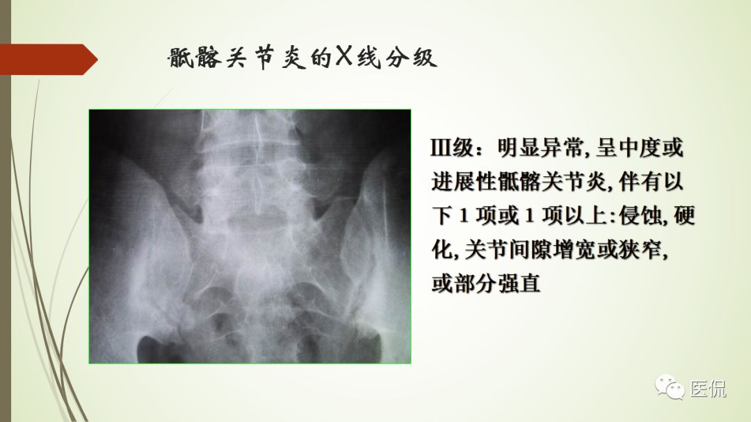 强直性脊柱炎x线表现(医学影像经典)