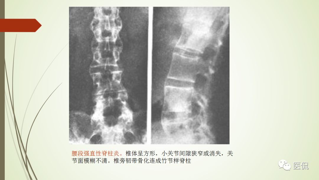 强直性脊柱炎x线表现(医学影像经典)