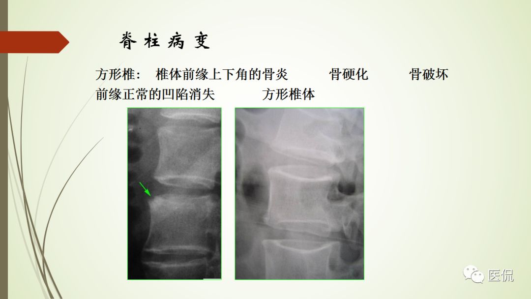 强直性脊柱炎x线表现医学影像经典