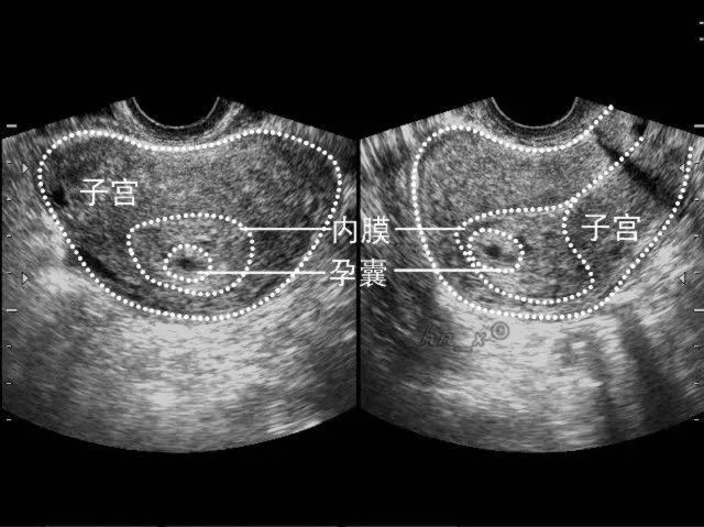 超声报告 目前宫内妊娠证据不足;左/右侧混合块,异位妊娠可能,请结合