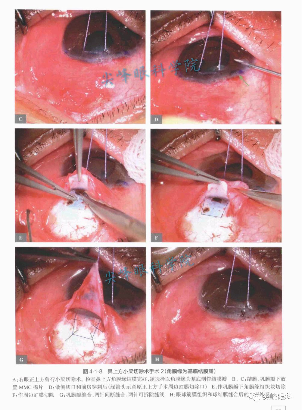 其他不同部位的小梁切除术 | 《图解青光眼手术操作与