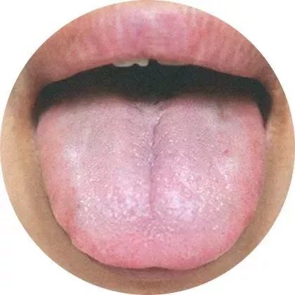 史上最全:130种高清舌诊图谱(吐血整理,建议收藏)_舌苔