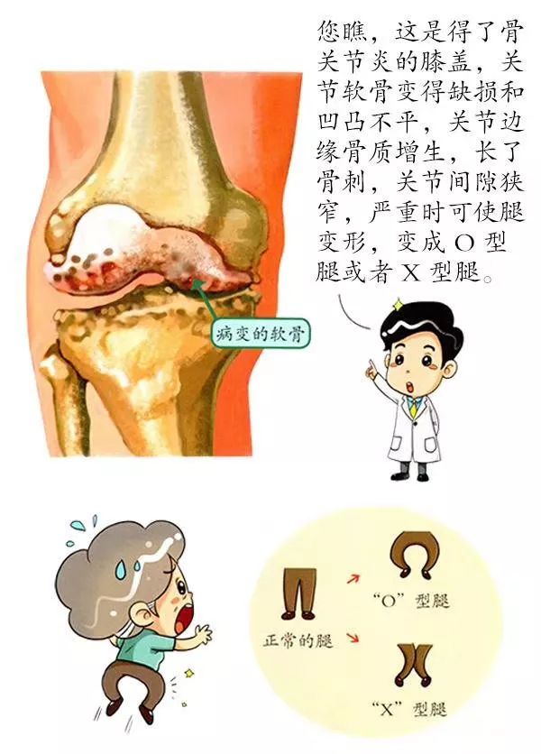 关于"膝关节骨性关节炎"的几点建议,值得一看!