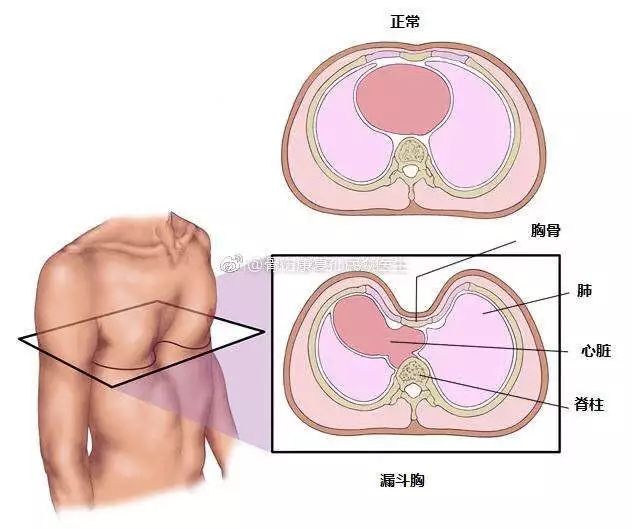 胸廓塌陷畸形 漏斗胸