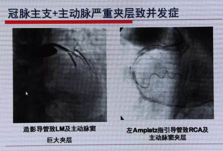 ccccisc2019方唯一教授夹层病变的导丝选择与操作技巧