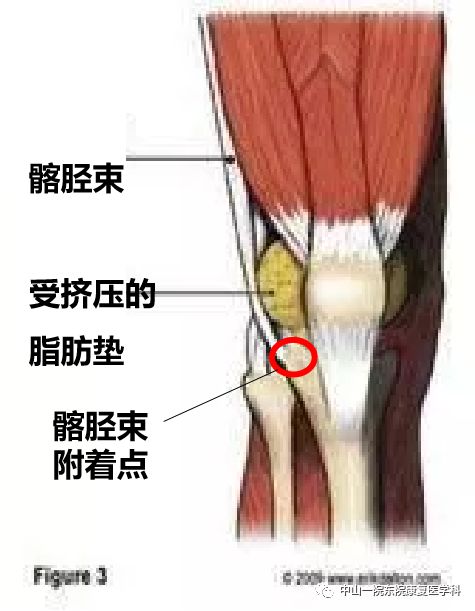 跑马季过后  我们有话说 上期我们讲到的膝外侧疼痛中的髂胫束综合征