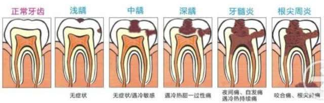 牙神经疼痛怎么办