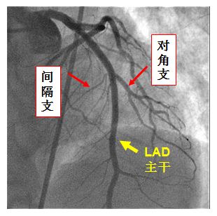 健康 正文  图5:前降支主干及其分成的间隔支和对角支 急性前壁心肌