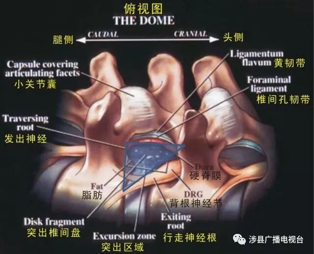 手术经安全三角进入,不易损伤神经根,手术安全性比开放手术更高.