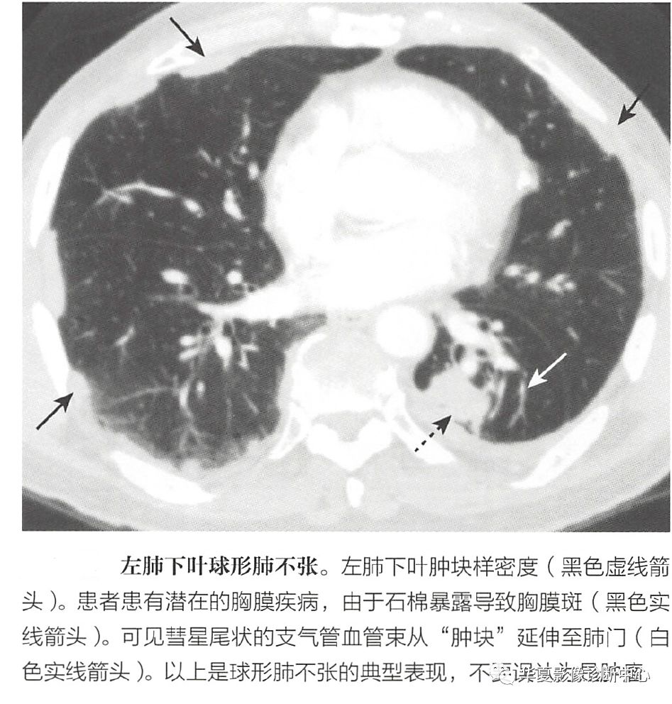 【基础复习】辨识肺不张