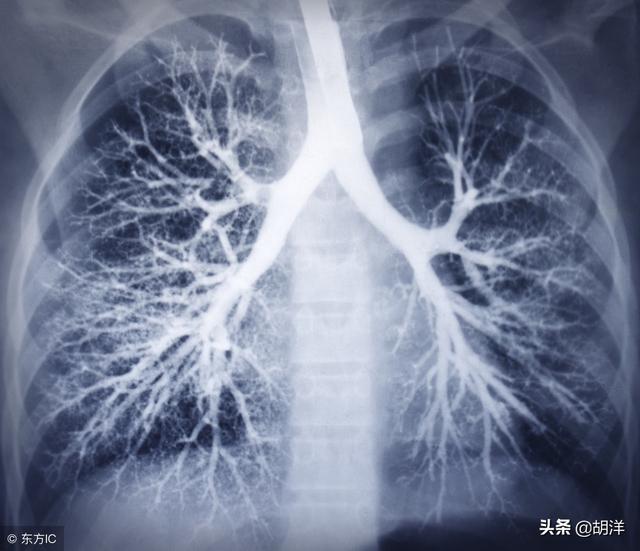 肺纹理增粗到底是什么原因,为什么现代人动不动拍片就
