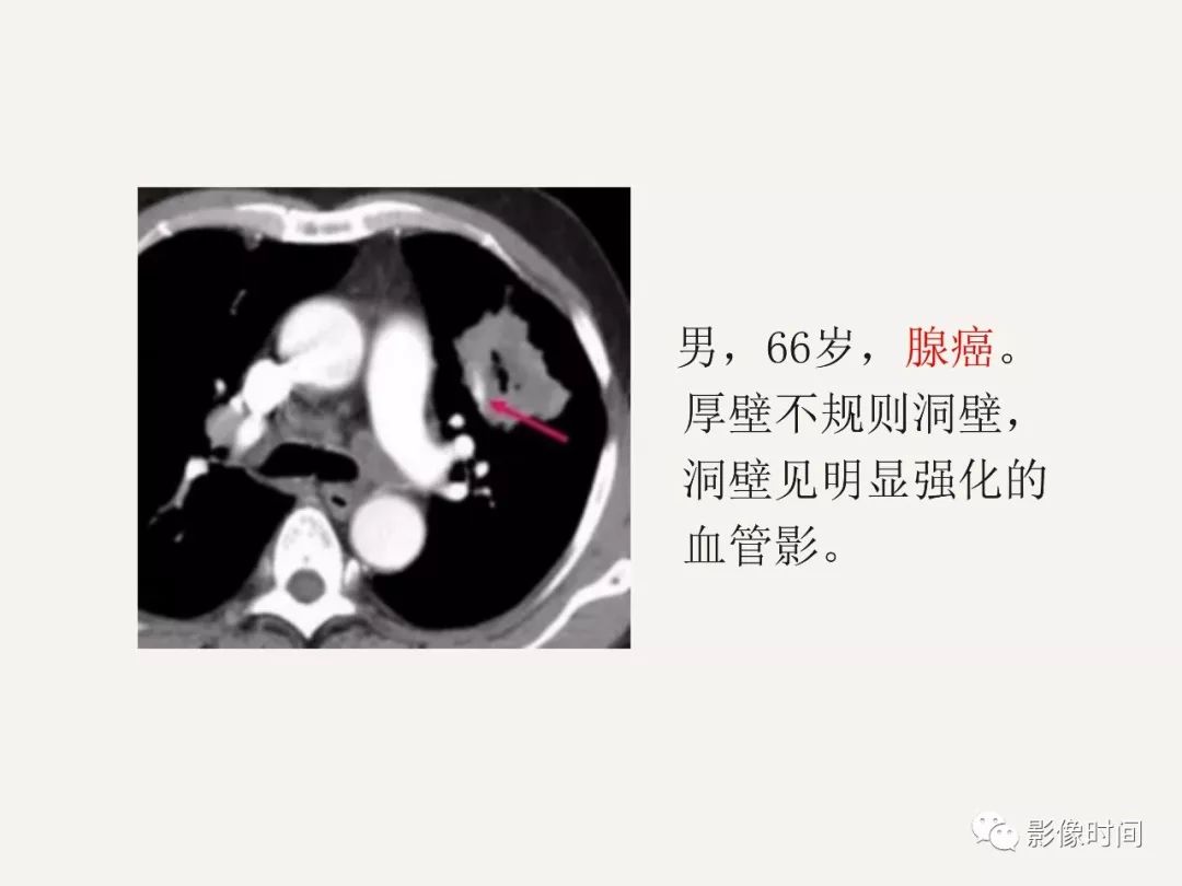 空洞型肺癌的 ct 诊断要点分析