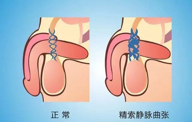 婚后2年不育,并检查出精液质量下降而前来四川省生殖专科医院男科中心