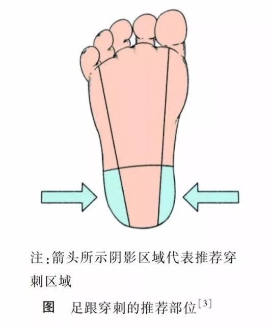 【共识】中国末梢采血操作共识