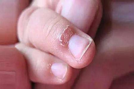 如果你家的宝宝指甲异常,请通过以下,来判断宝宝的健康状况