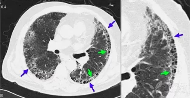 肺结核,纤维化:双上肺可见条索状灶和结节灶.