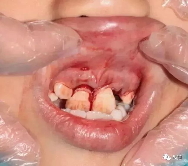 我们可以看到,牙齿半脱位,牙龈撕裂.