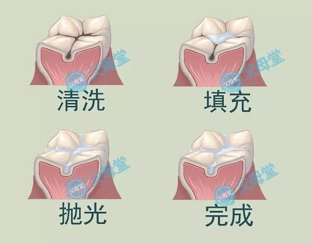 原創
            塗氟or窩溝封閉怎麼選？權威回答來了，再也不用擔心寶寶蛀牙 親子 第2張