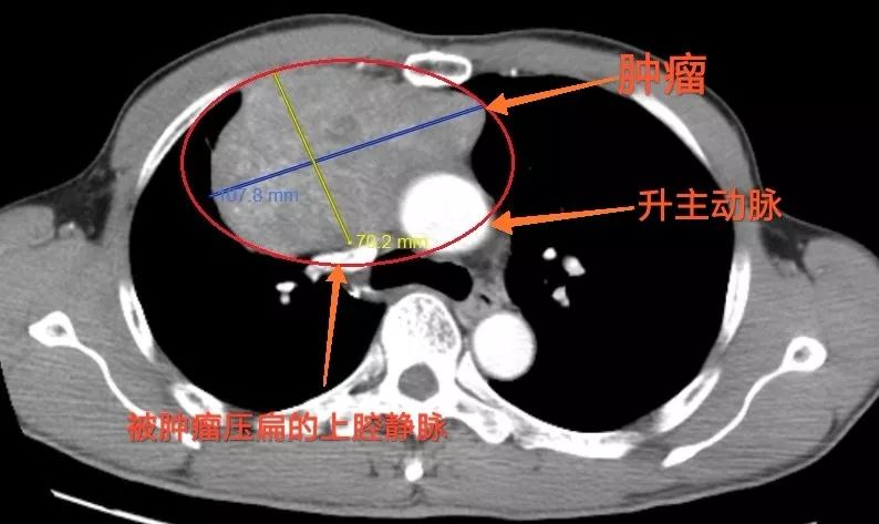 周先生的胸部增强ct(红圈内为肿瘤)