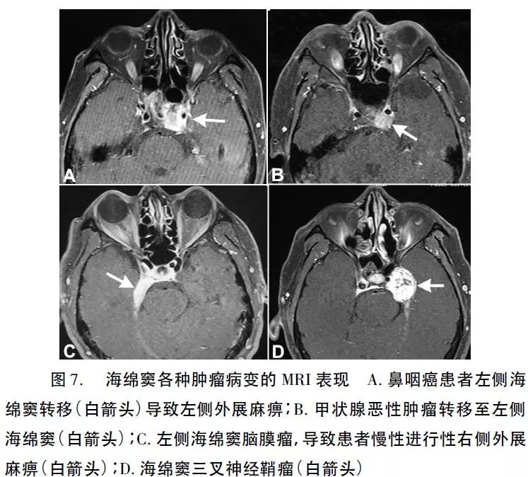 图文并茂海绵窦病变的解剖临床特征诊断及鉴别诊断