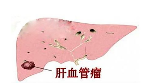 体检查出肝内血管瘤,是怎么回事?严不严重?