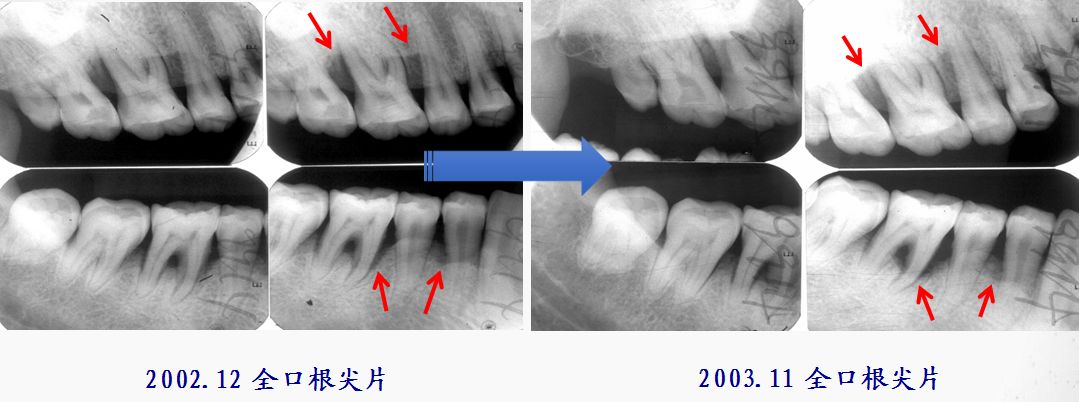 一例侵袭性牙周炎患者牙周种植修复治疗的15年随访观察以菌斑控制为