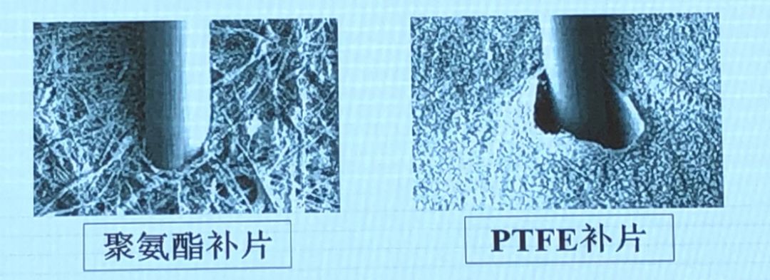 随着技术的进步,自体静脉补片,生物补片(牛心包),人工合成补片不断有