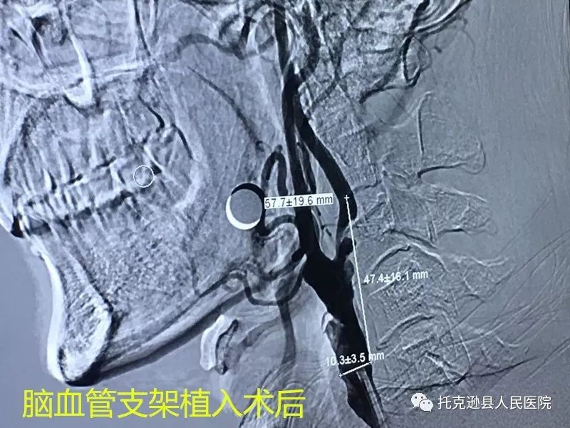 我院成功开展首例脑血管支架植入术