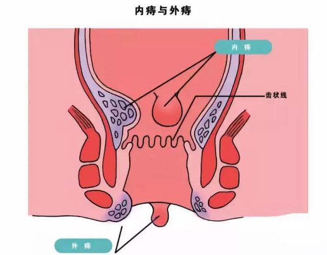 内痔,外痔,混合痔,怎样区分?