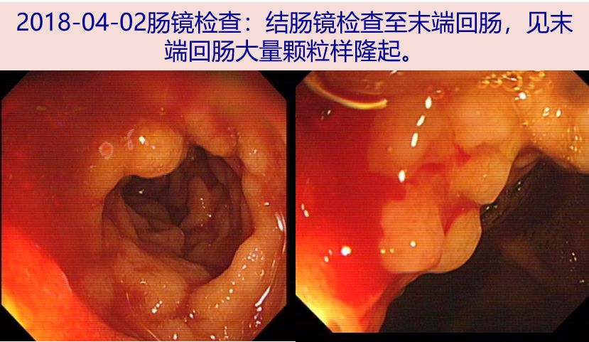 探案糊状大便痛经不孕真相只有一个