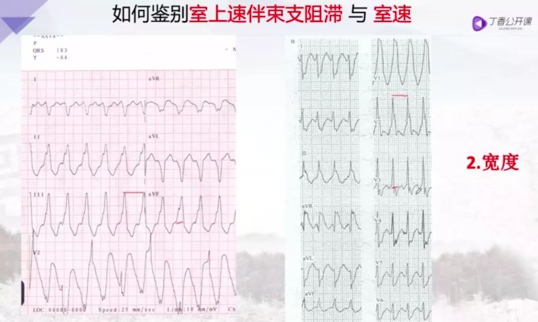 图1:来源孙雅逊《危急重症心电图》如图 1 所示,两个都是宽 qrs 波