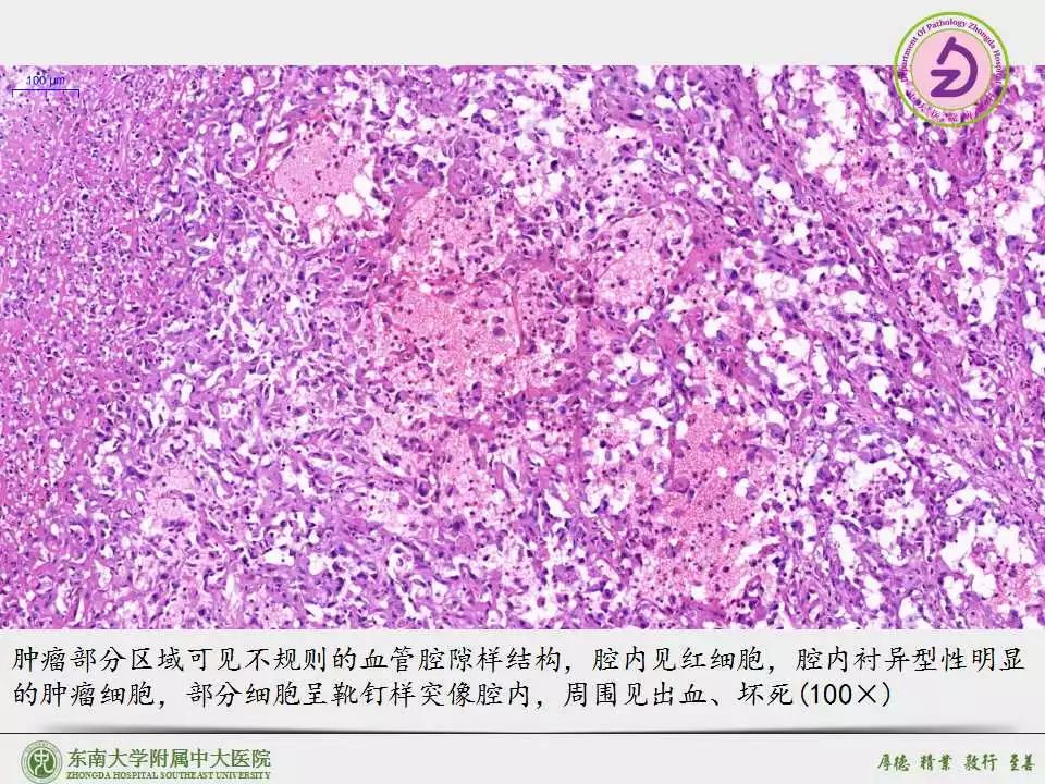 胃上皮样血管肉瘤epithelioidangiosarcomaea讨论病例东南大学附属