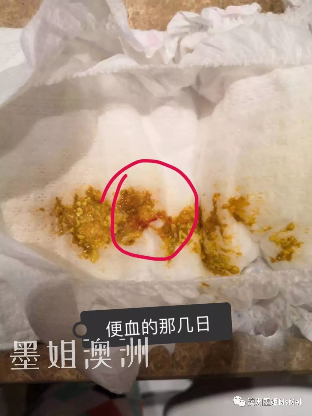 真实案例宝宝湿疹反复腹泻便血咳嗽不断分享几个真实故事帮你解决这些