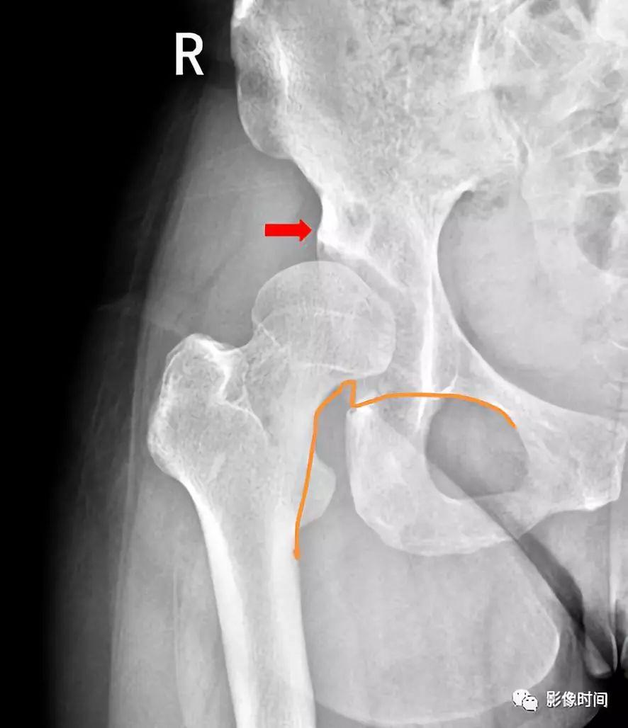 髋臼外上缘变形,密度增加 (红色箭头),不均,股骨头稍向上移位,沈通氏