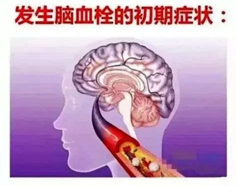 【健康养生】脑血栓怎么治疗 脑血栓前兆的十个表现