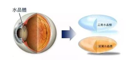 白內障如何趕走？人工晶狀體來協助 科技 第3張