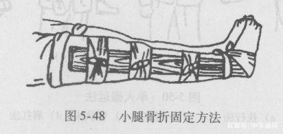 症状:局部疼痛,移动伤肢时大腿骨折夹板固定法股骨骨折健肢固定法疼痛