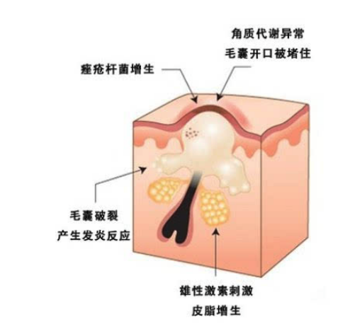 脸上长闭合怎么办