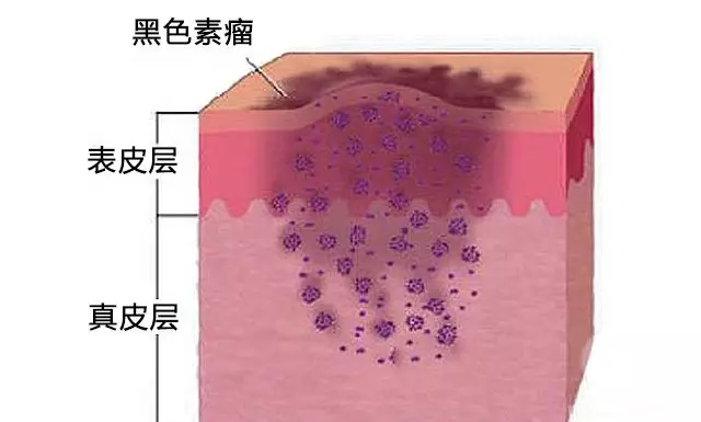 说说黑色素瘤那些事