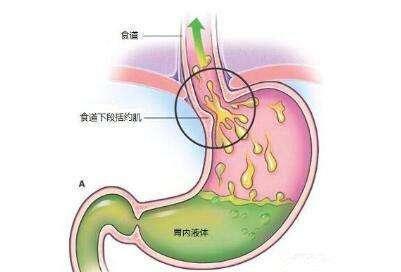 胃反酸嗳气怎么办