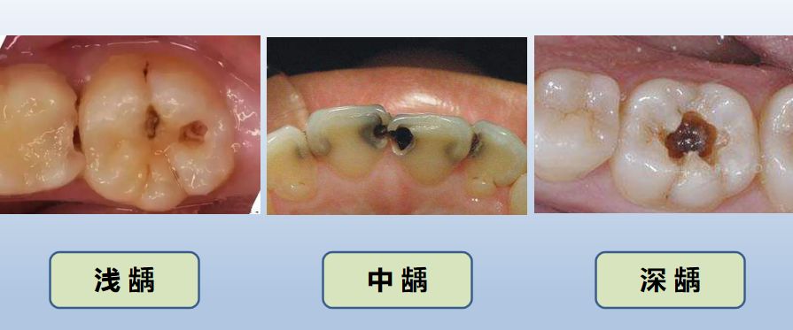 破坏只在牙釉质内,一般无明显龋洞,除了可视的小黑点,其他没感觉.