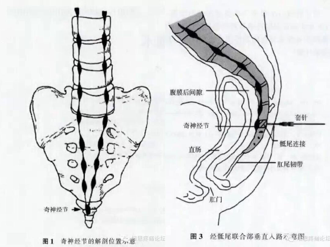 上图为奇神经节在骶尾部的解剖位置及穿刺针进针位置上图为b超 c臂机