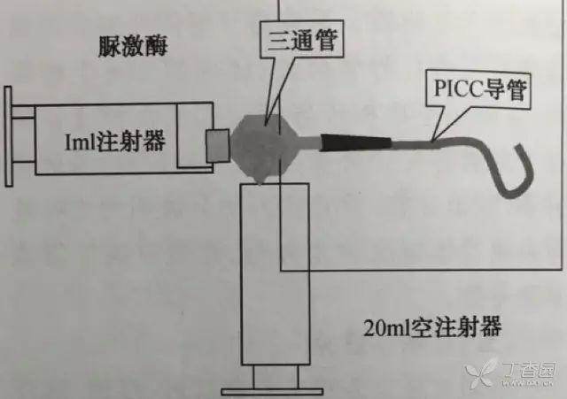 回抽后关闭该通路,使导管内形成负压,开放三通使脲激酶注射器与导管