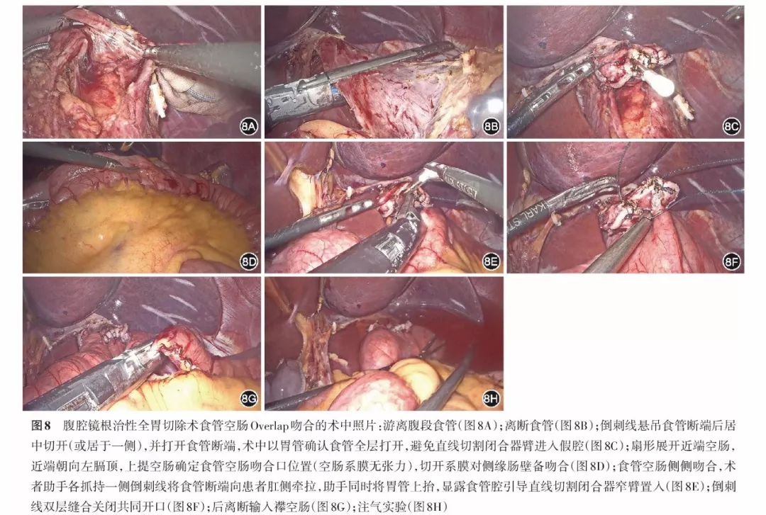 前者主要是overlap法,后者包括食管空肠功能性端端吻合及其改良π形吻