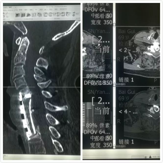 延安市首例颈前路锁骨近端切除入路治疗颈胸交界段脊柱结核在延安市