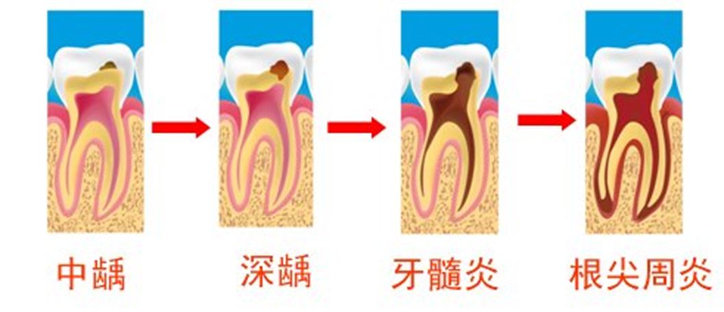 走进口腔——龋病的危害