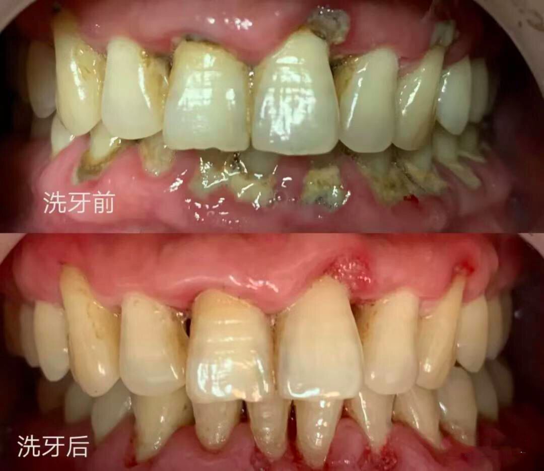 需要强调的是,定期洗牙并不仅仅针对牙周炎患者,而是所有人.