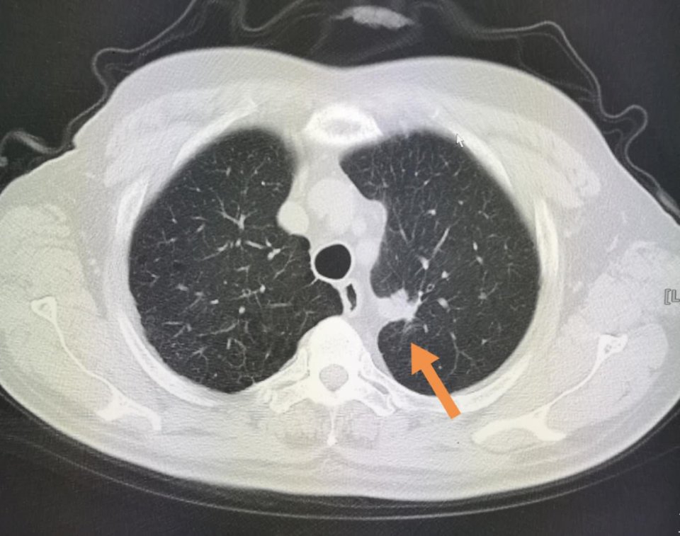 符合混合型转移瘤特点,进一步检查肺部ct,发现一个两厘米的小肺癌