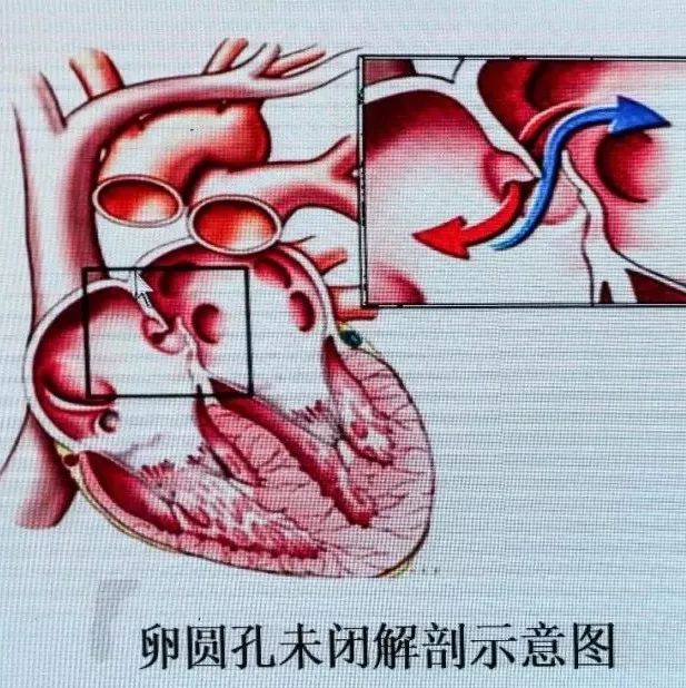 43ccif2018丨张军教授:超声心动图及发泡实验与卵圆孔未闭